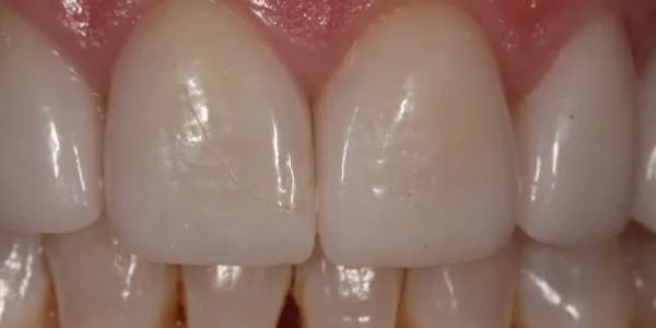 Dental crown after