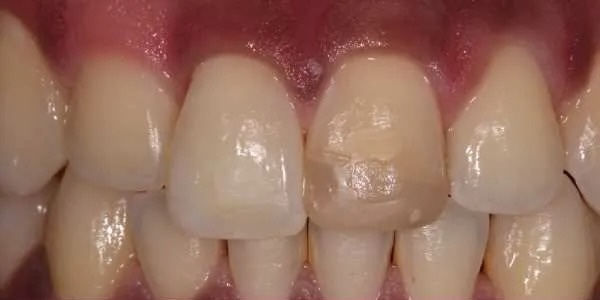 Dental Crowns before