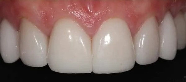 Dental crowns 2 after