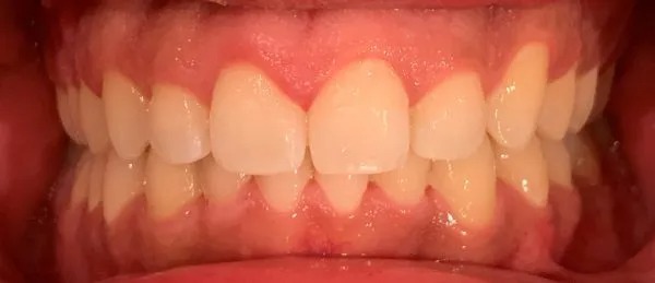 Teeth alignment after