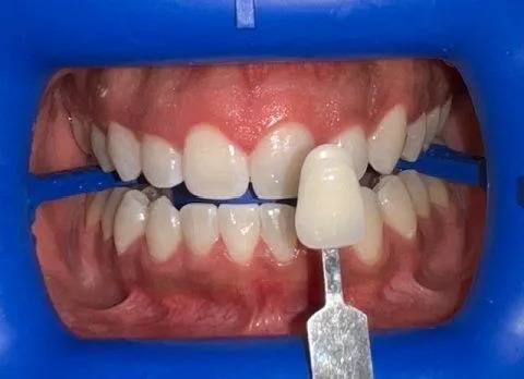 Whitening after