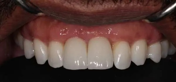 Dental implants after