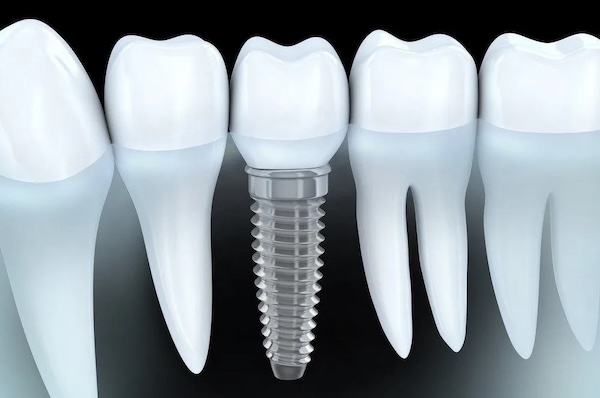 Dental implants