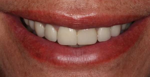 Veneers after