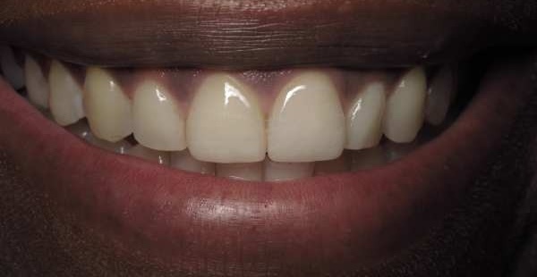 Veneers after 2