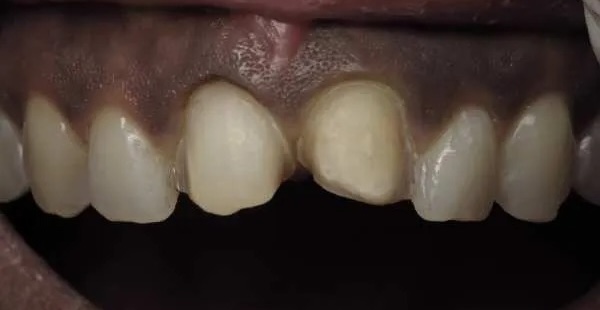 Veneers before 2